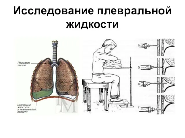 Исследование плевральной жидкости