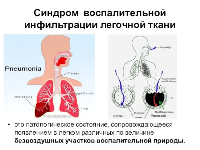 Синдром воспалительной инфильтрации легочной ткани это патологическое состояние, сопровождающееся появлением