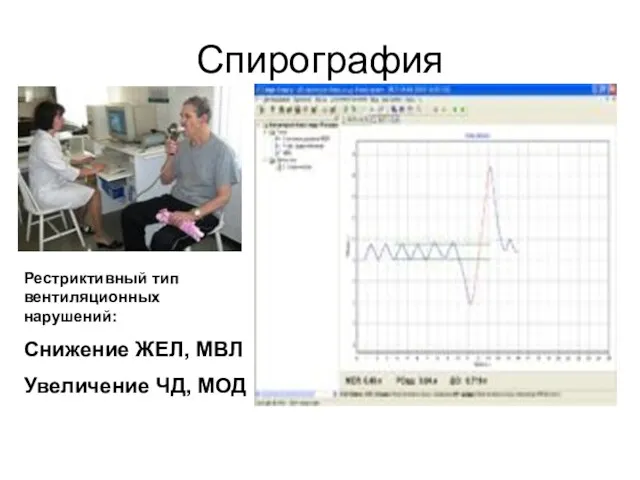 Спирография Рестриктивный тип вентиляционных нарушений: Снижение ЖЕЛ, МВЛ Увеличение ЧД, МОД