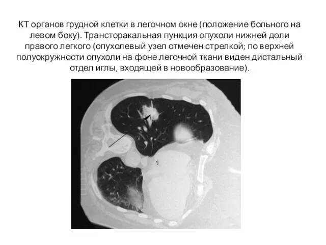 КТ органов грудной клетки в легочном окне (положение больного на левом боку). Трансторакальная