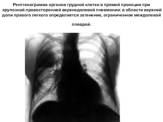 Рентгенограмма органов грудной клетки в прямой проекции при крупозной правосторонней верхнедолевой пневмонии: в