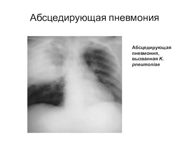 Абсцедирующая пневмония Абсцедирующая пневмония, вызванная K. pneumoniae