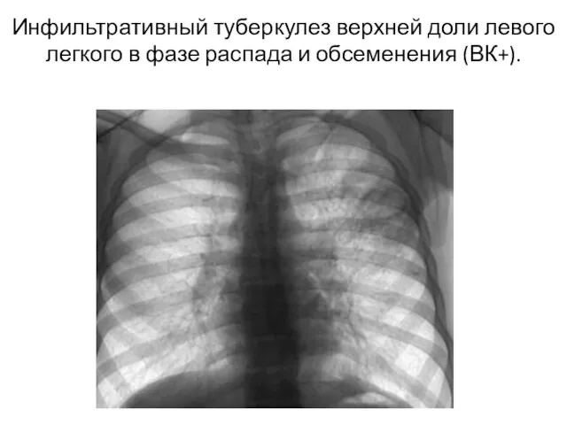 Инфильтративный туберкулез верхней доли левого легкого в фазе распада и обсеменения (ВК+).