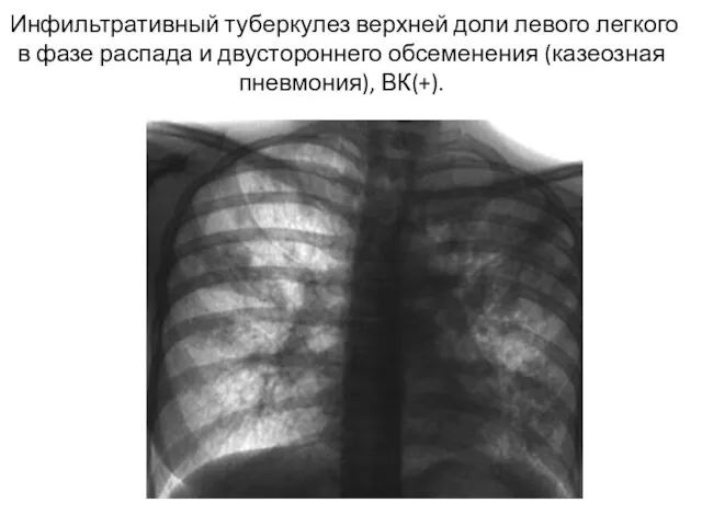 Инфильтративный туберкулез верхней доли левого легкого в фазе распада и двустороннего обсеменения (казеозная пневмония), ВК(+).