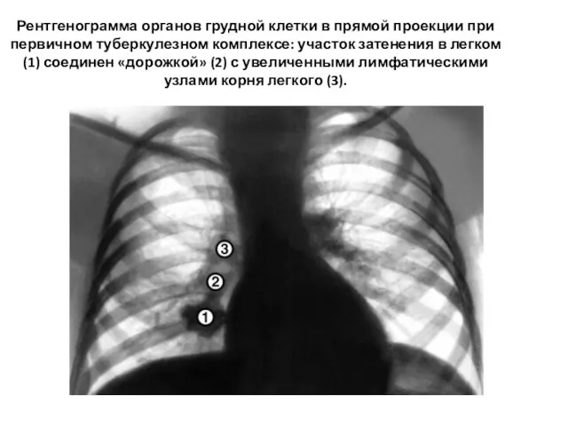 Рентгенограмма органов грудной клетки в прямой проекции при первичном туберкулезном комплексе: участок затенения