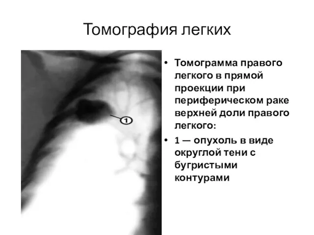 Томография легких Томограмма правого легкого в прямой проекции при периферическом раке верхней доли