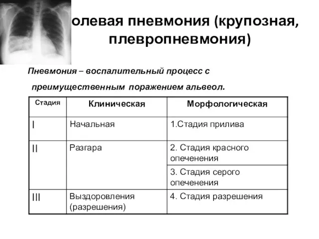 Долевая пневмония (крупозная, плевропневмония) Пневмония – воспалительный процесс с преимущественным поражением альвеол.