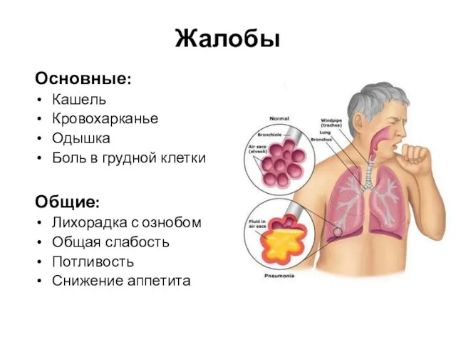 Жалобы Основные: Кашель Кровохарканье Одышка Боль в грудной клетки Общие: Лихорадка с ознобом