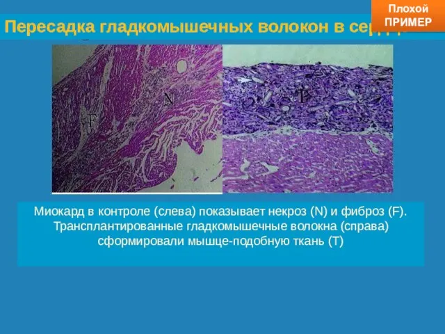 Title Пересадка гладкомышечных волокон в сердце Миокард в контроле (слева)