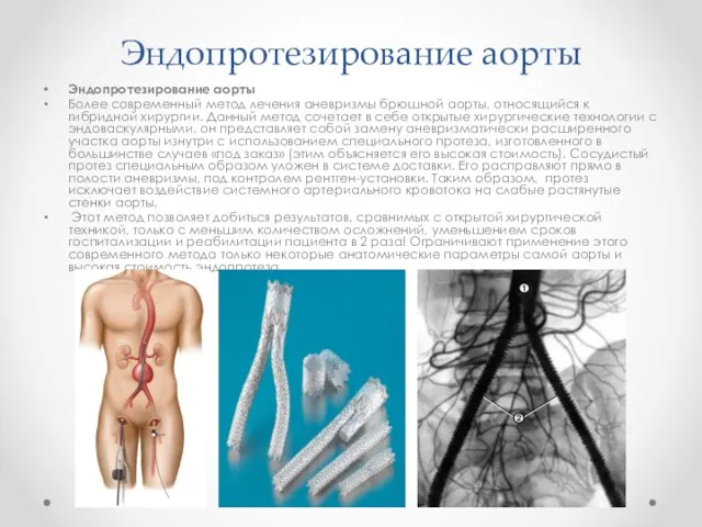 Эндопротезирование аорты Эндопротезирование аорты Более современный метод лечения аневризмы брюшной