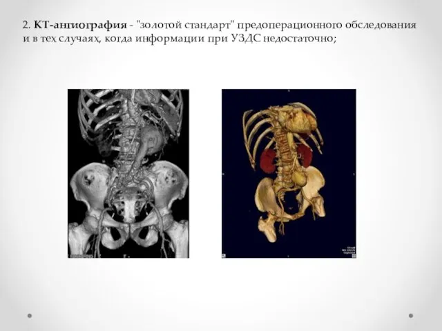 2. КТ-ангиография - "золотой стандарт" предоперационного обследования и в тех случаях, когда информации при УЗДС недостаточно;