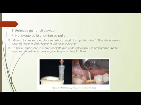 3) Polissage du trottoir cervical . 4) Nettoyage de la