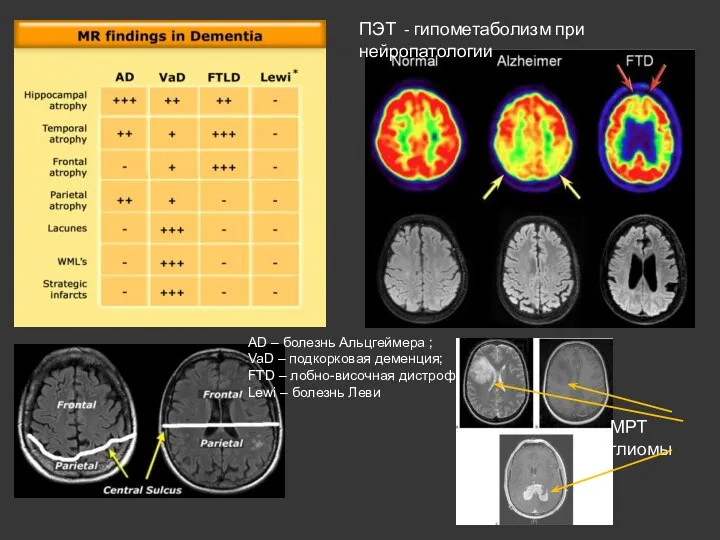 ПЭТ - гипометаболизм при нейропатологии AD – болезнь Альцгеймера ;