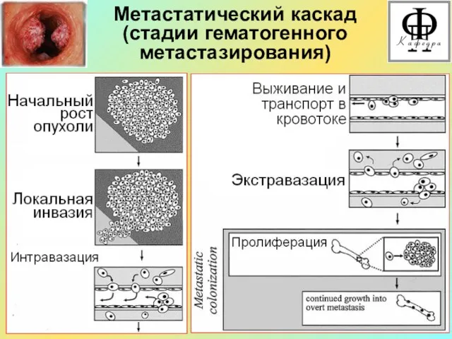 Метастатический каскад (стадии гематогенного метастазирования)