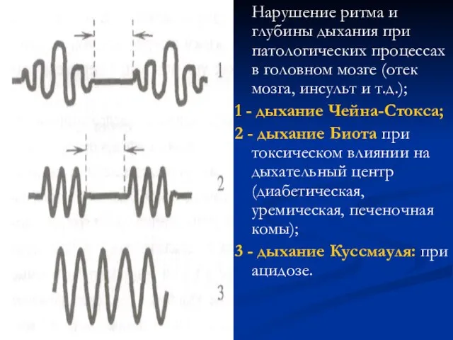 Нарушение ритма и глубины дыхания при патологических процессах в го­ловном