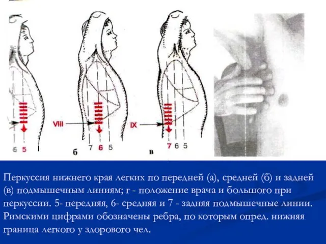 Перкуссия нижнего края легких по передней (а), средней (б) и