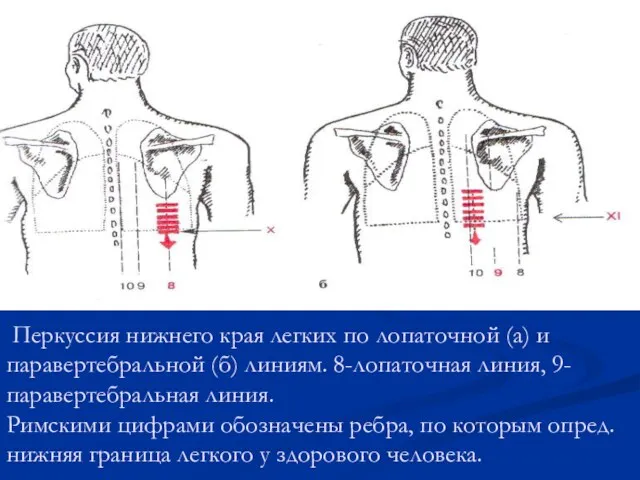 Перкуссия нижнего края легких по лопаточной (а) и паравертебральной (б)