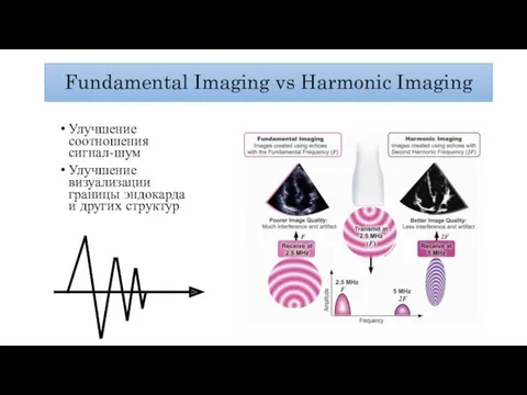 Fundamental Imaging vs Harmonic Imaging Улучшение соотношения сигнал-шум Улучшение визуализации границы эндокарда и других структур