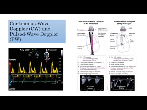 Continuous-Wave Doppler (CW) and Pulsed-Wave Doppler (PW)