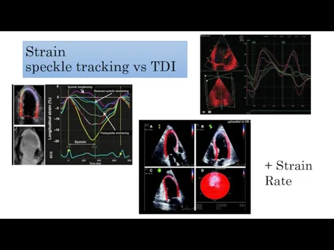 Strain speckle tracking vs TDI + Strain Rate