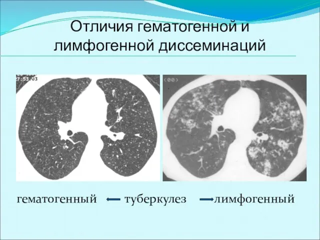 Отличия гематогенной и лимфогенной диссеминаций гематогенный туберкулез лимфогенный