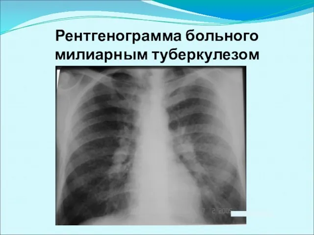 Рентгенограмма больного милиарным туберкулезом