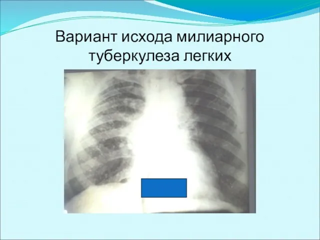 Вариант исхода милиарного туберкулеза легких