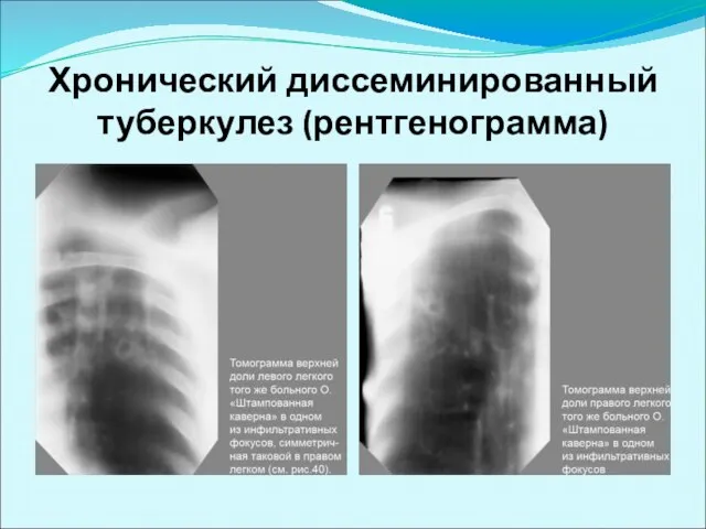Хронический диссеминированный туберкулез (рентгенограмма)