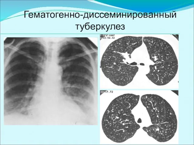 Гематогенно-диссеминированный туберкулез