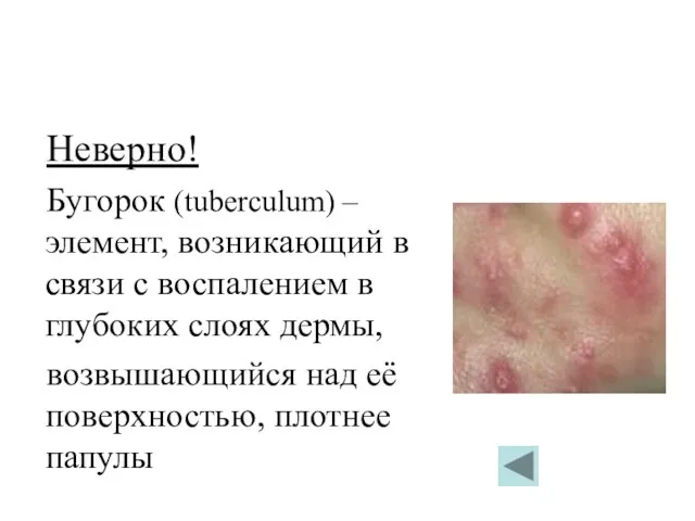Неверно! Бугорок (tuberculum) – элемент, возникающий в связи с воспалением