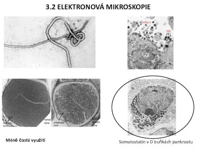 3.2 ELEKTRONOVÁ MIKROSKOPIE Somatostatin v D buňkách pankreatu Méně časté využití