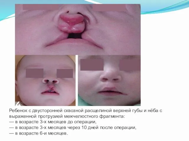 Ребенок с двусторонней сквозной расщелиной верхней губы и нёба с
