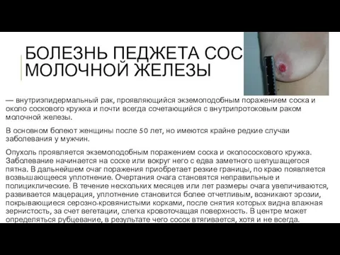 БОЛЕЗНЬ ПЕДЖЕТА СОСКА МОЛОЧНОЙ ЖЕЛЕЗЫ — внутриэпидермальный рак, проявляющийся экземоподобным