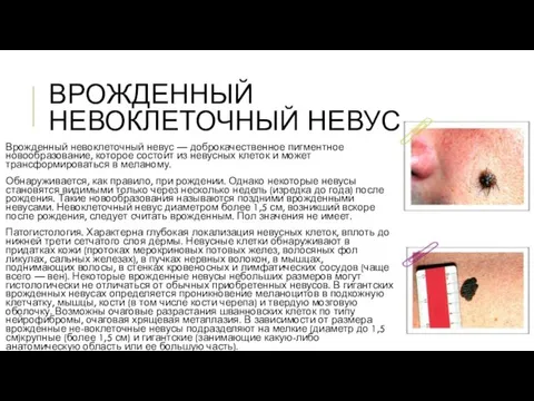 ВРОЖДЕННЫЙ НЕВОКЛЕТОЧНЫЙ НЕВУС Врожденный невоклеточный невус — доб­рокачественное пигментное новообразование,