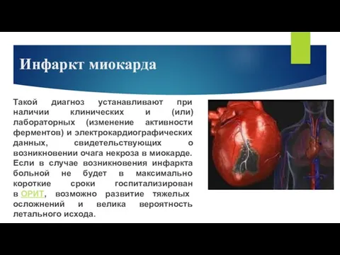 Инфаркт миокарда Такой диагноз устанавливают при наличии клинических и (или)