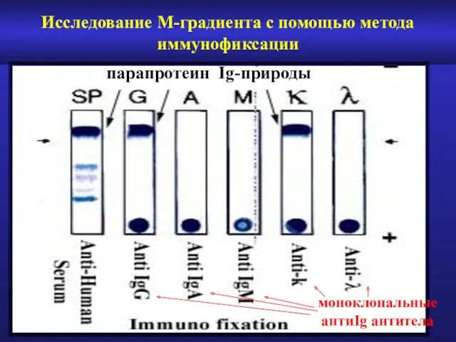 Исследование М-градиента с помощью метода иммунофиксации моноклональные антиIg антитела парапротеин Ig-природы