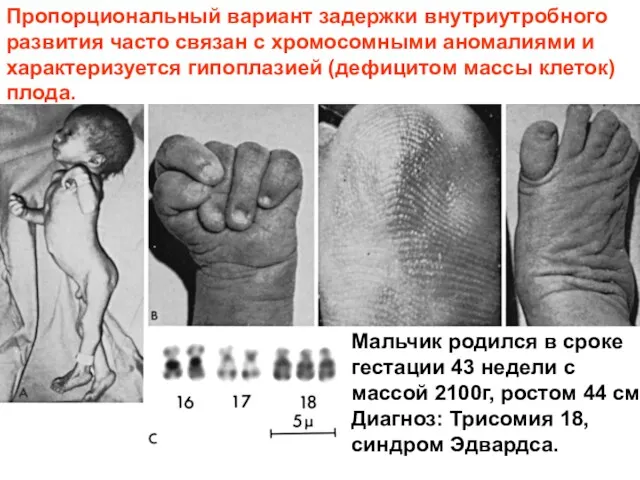 Пропорциональный вариант задержки внутриутробного развития часто связан с хромосомными аномалиями