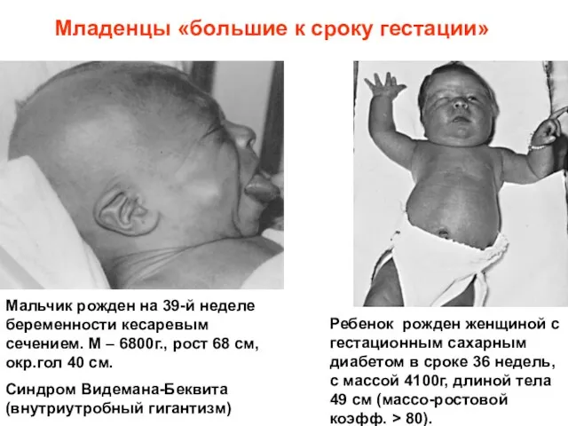 Младенцы «большие к сроку гестации» Мальчик рожден на 39-й неделе