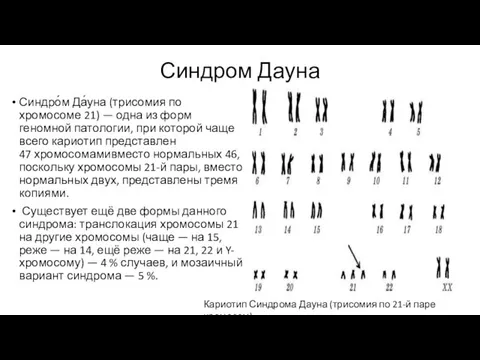 Синдром Дауна Синдро́м Да́уна (трисомия по хромосоме 21) — одна