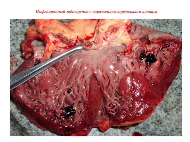 Инфекционный эндокардит с поражением аортального клапана