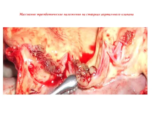 Массивные тромботические наложения на створках аортального клапана