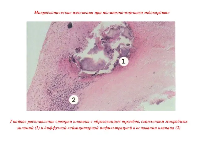 Микроскопические изменения при полипозно-язвенном эндокардите Гнойное расплавление створки клапана с