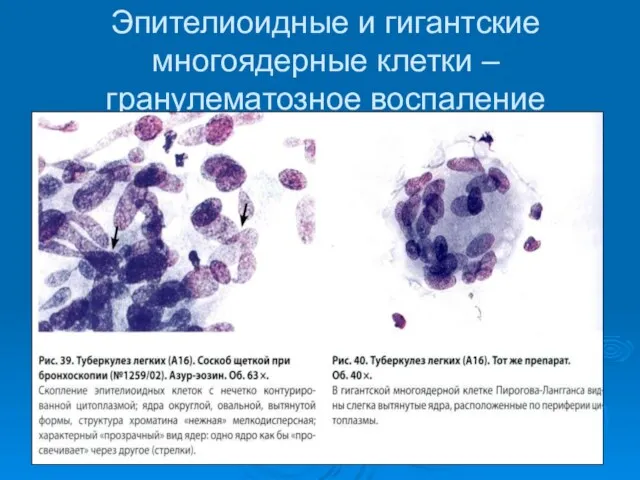 Эпителиоидные и гигантские многоядерные клетки – гранулематозное воспаление