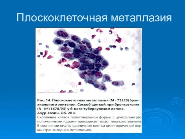 Плоскоклеточная метаплазия