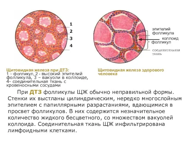 При ДТЗ фолликулы ЩЖ обычно неправильной формы. Стенки их выстланы