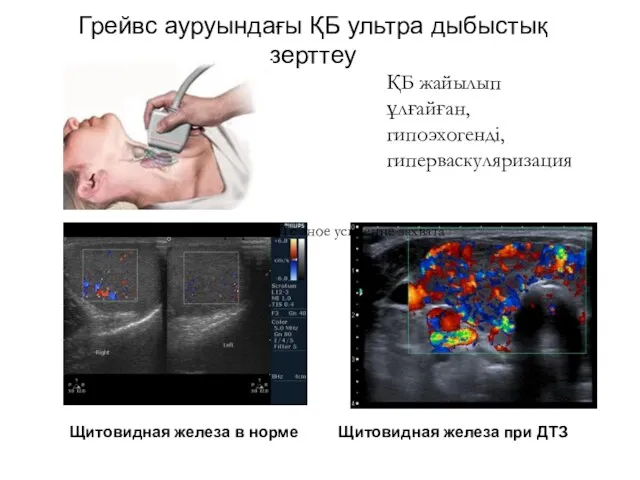 Грейвс ауруындағы ҚБ ультра дыбыстық зерттеу Щитовидная железа в норме