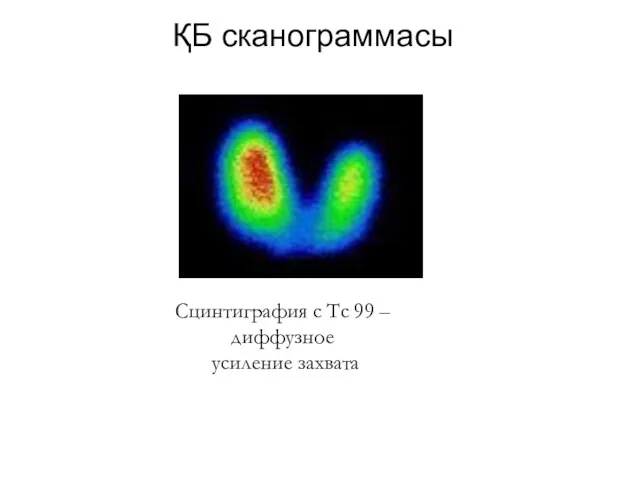 ҚБ сканограммасы Сцинтиграфия с Тс 99 – диффузное усиление захвата