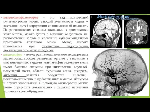 пневмоэнцефалография - это вид контрастной рентгенографии черепа, дающий возможность судить