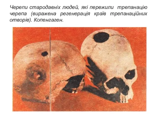 Черепи стародавніх людей, які пережили трепанацію черепа (виражена регенерація країв трепанаційних отворів). Копенгаген.