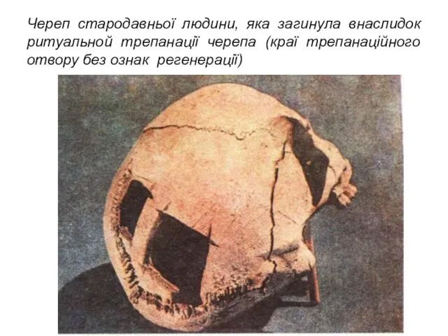 Череп стародавньої людини, яка загинула внаслидок ритуальной трепанації черепа (краї трепанаційного отвору без ознак регенерації)